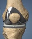 Joint Replacement